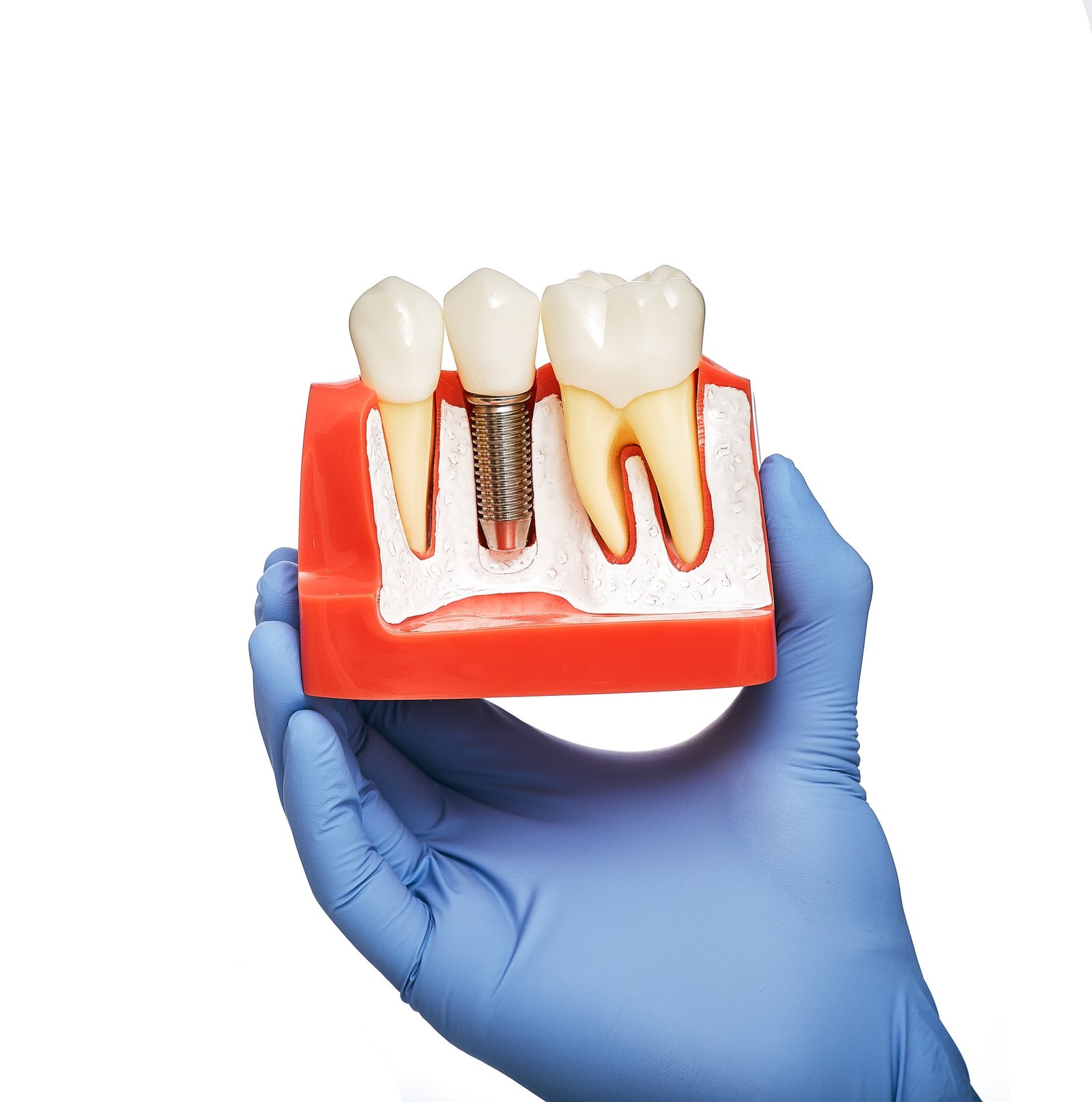 Dentist holding an anatomical model of teeth with a dental implant in his hand, close-up. Dental